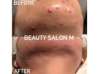 エム(M)/繰り返す顎(あご)ニキビケア