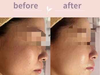 アール(R)/毛穴デトックスプログラム