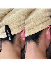 シェリー(Cherie)/うなじWAX+光脱毛