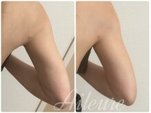 エルール トータルビューティ(Aileure total beauty)/ダウンタイムケア二の腕