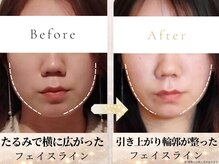 アロハ(ALOHA.)の雰囲気（一度で変化を実感。「変わった？」と聞かれるフェイスライン）