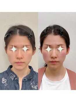 小顔22 ボルティ 赤坂支店(Bolty)/【悩み】頬の出っ張り、長い顎