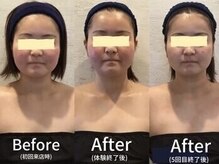 小顔フェイスラボ 岡崎店(小顔 Face Labo.)/◆小顔コルギ Before→After◆