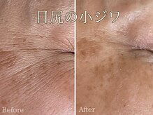 シエナ(ciena)/BBL光フェイシャル症例写真♪