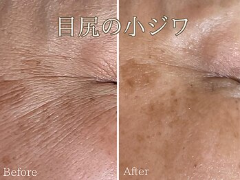 シエナ(ciena)/BBL光フェイシャル症例写真♪