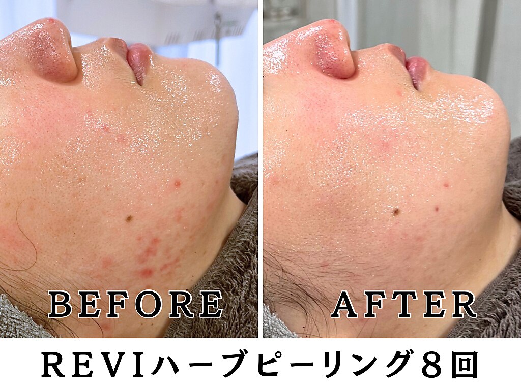 REVI ハーブピーリングに関するエステサロン つや肌×ハーブピーリング