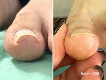 コバコ(kobaco)/巻き爪ケア　3回目
