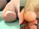 巻き爪ケア 3回目