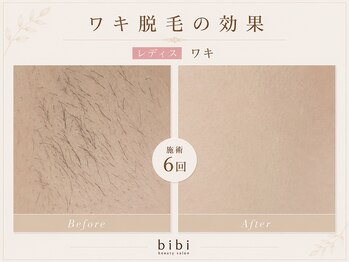 ビビ(bibi)/レディースワキ脱毛施術6回