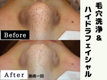 シャルムクリニカルサロン 池袋(Charme clinical salon)/毛穴洗浄＆ハイドラフェイシャル