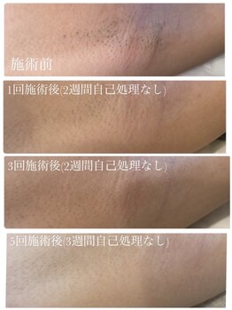 スウィート 矢場町店(Sweet)/脇脱毛