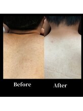 モンド(Mondo)/メンズ脱毛【身体】