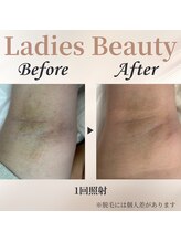 シャーロック(4869Sherlock)/ワキ脱毛BeforeAfter