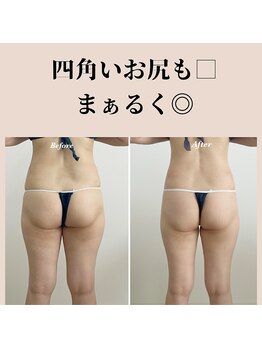 リュクス(LUXE)/30代丸いお尻にお尻に変身!