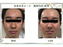 サロンドエクラ 南堀江(salon de eclat)/水素水光ピール