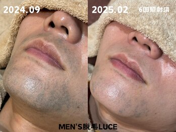 ルーチェ/【ヒゲ脱毛】毎回変化が見える