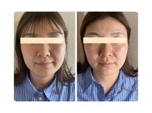 ジョワ 北堀江(joie)/小顔矯正/毛穴洗浄/ニキビ/シミ