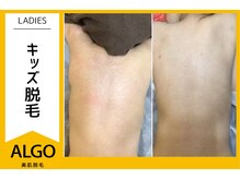 アルゴ 越前店(ALGO)/キッズ背中脱毛