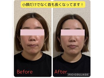 ベルフルール(Belle Fleur)/小顔矯正