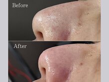 ティーツリー 名古屋 桜山(Tea Tree)/【毛穴ケア・毛穴洗浄】