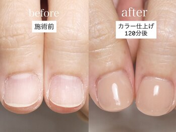 メイシンネイル(Meixingnail)/ヌーディーカラーの深爪矯正