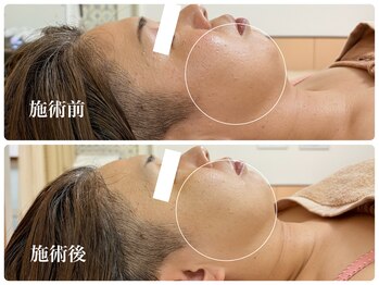 キーオブフェイス(Key of Face)/「RED SHOT」で痩せて見えた♪