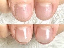 1回の施術で美しい爪へ【自爪育成/長さだし/深爪/フィルイン】