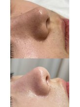 ルミナエステ(LUMINA ESTH)/毛穴／毛穴洗浄／毛穴ケア｜症例