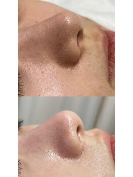 ルミナエステ(LUMINA ESTH)/毛穴/毛穴洗浄/毛穴ケア|症例