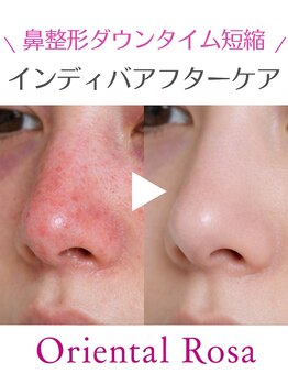 オリエンタルローザ 表参道(Oriental Rosa)/隆鼻術/鼻尖端術/鼻幅縮小術ケア