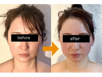 イーリス(i-ris)の写真/【本格小顔矯正×美容整体】小顔はもちろん、たるみ改善・左右の歪み等、なりたい美小顔へ導きます★