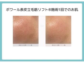 ケー(K)の写真/毛穴の悩みお任せください♪たるみ毛穴を改善する最新技術『表皮立毛筋リフト』で目指す理想のなめらかな肌