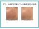 ケー(K)の写真/毛穴の悩みお任せください♪たるみ毛穴を改善する最新技術『表皮立毛筋リフト』で目指す理想のなめらかな肌