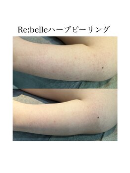 サラ/Re:belleハーブピーリング