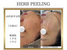 ロージー(ROSY)/ハーブピーリング/阿南/徳島