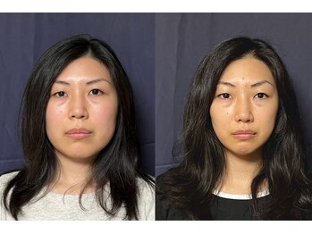 美容整体 アルマ/小顔10回目