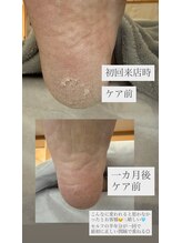 フットミー(foot mii)/ケア前の比較　１ヶ月後