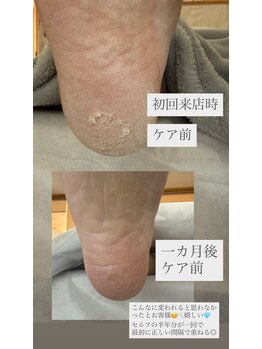 フットミー(foot mii)/ケア前の比較　１ヶ月後