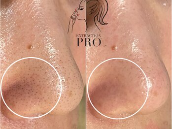 ルアナ(Luana)/毛穴エクストラクション+シリカ