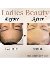 シャーロック(4869Sherlock)/おでこBeforeAfter