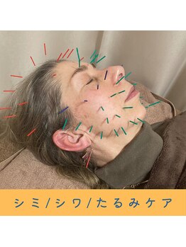 いつつのき/美容鍼