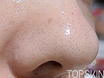 トップスキン 名駅(TOPSKIN)/黒ずみいちご鼻が劇的変化♪