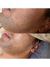 《men's》清潔感アップ！医療提携最短卒業脱毛【お顔全体】髭脱毛4980円