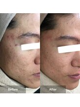 モカ 天王寺店(MOKA)/おでこニキビケア　シミケア