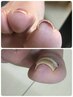 巻き爪矯正 1趾