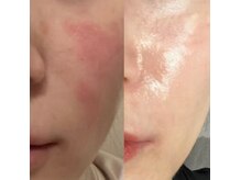 ルピナス ロッポンギ(Rupinus ROPPONGI)の雰囲気（外的トラブル→鎮静ケア＋パーソナルホームケア肌管理結果）