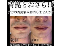 ハモンド(Hammond)/髭脱毛