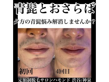 ハモンド(Hammond)/髭脱毛