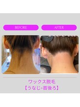 レビア(Revia)/うなじ＋首うしろ/before→after