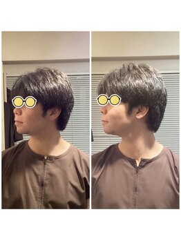 エクステンド鍼灸整体院(extend鍼灸整体院)/施術後 鍼